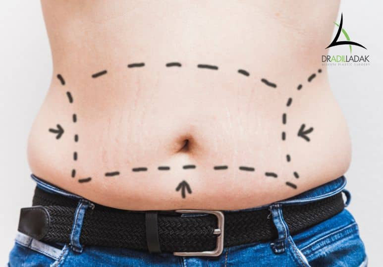 Liposuction for Men: What You Need to Know